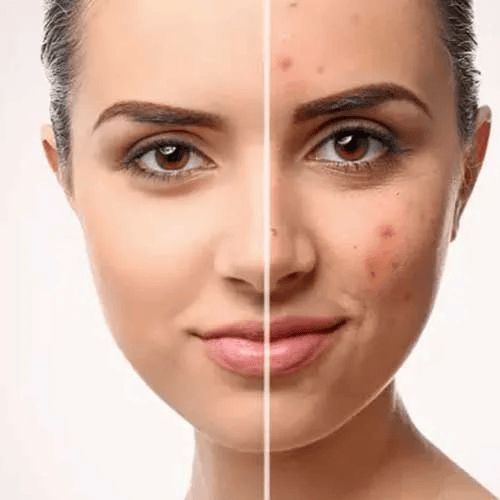 Benefits of Acne Treatment