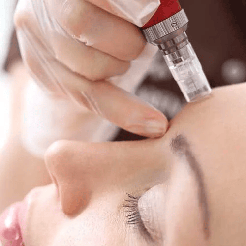 Benefits of Acne Treatment